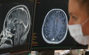 COVID và não bộ: các nhà khoa học đang nghiên cứu cách các tổn thương xuất hiện