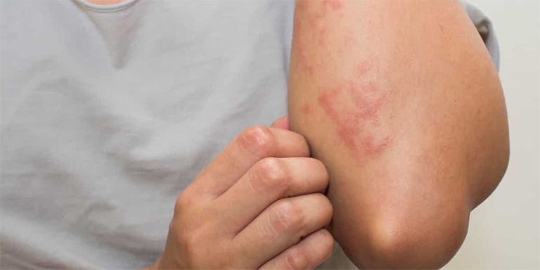 Ngứa ngoài da là một trong những bệnh ngoài da dễ mắc vào mùa đông