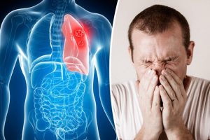 Dấu hiệu nhận biết u phổi ác tính và cách cải thiện