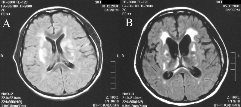 Hình ảnh MRI cho thấy dấu hiệu teo não do tuổi già