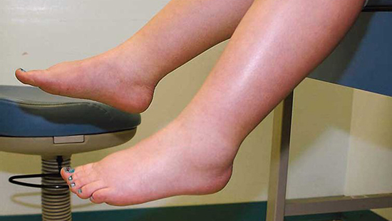 Phù chân là một trong những triệu chứng phổ biến của bệnh suy tim